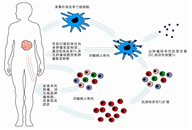 免疫细胞治疗模式图.png