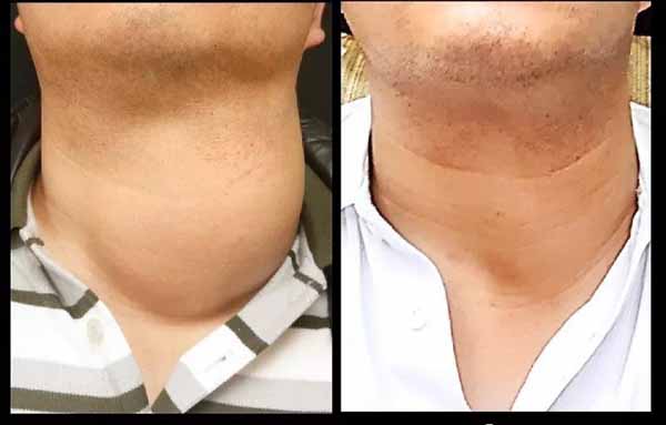 刘先生台湾治疗甲状腺