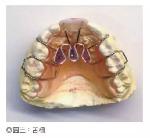 前牙开咬的齿颚矫正治疗