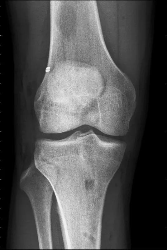 前十字韧带重建合并外侧肌腱固定术后Ｘ光