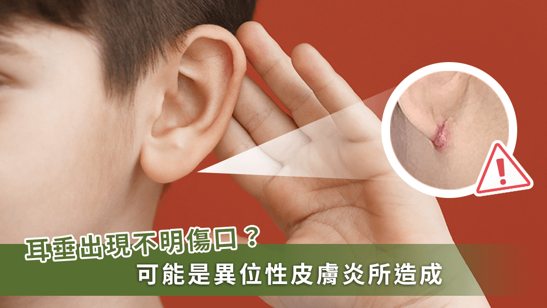耳垂下方有傷口、濕疹？可能是異位性皮膚炎的前期征兆！