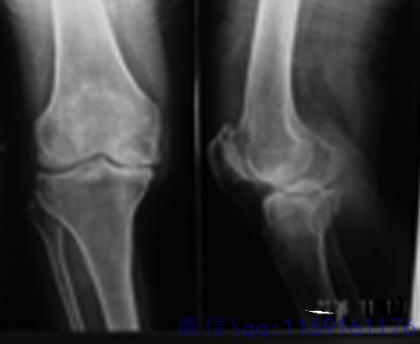 膝盖骨质增生CT图 (12).jpg