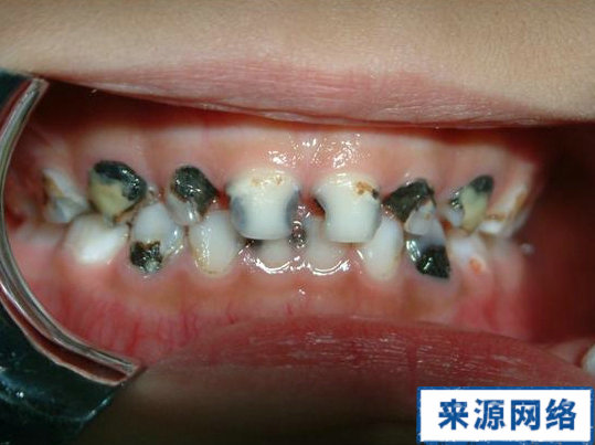 门牙龋齿 初期图片