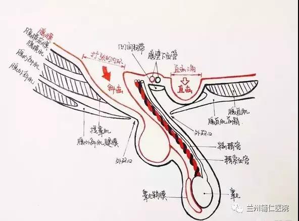 腹外疝结构示意图图片