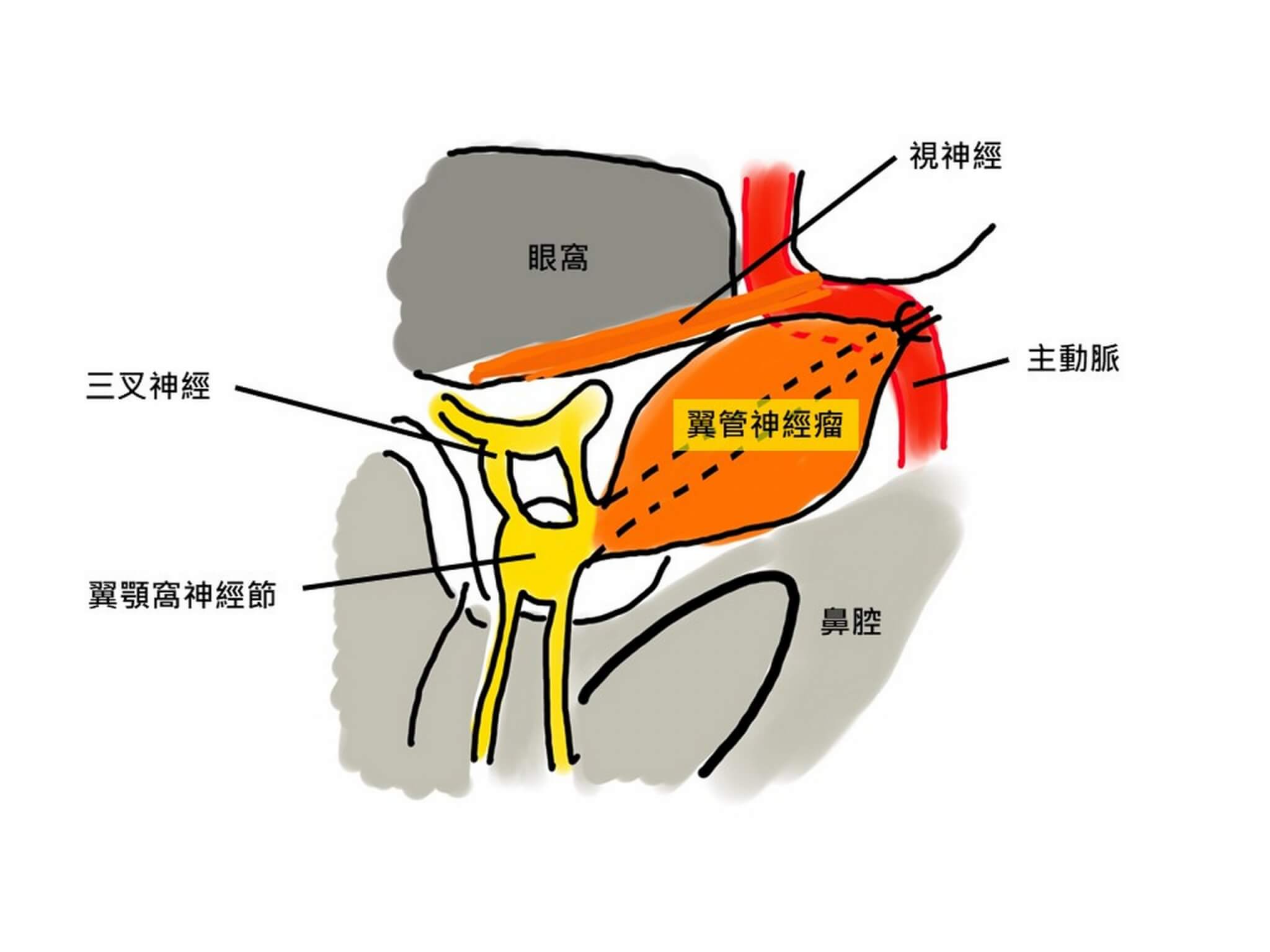 全台湾首例！鼻水狂流原来是全球不到20例的罕见神经瘤