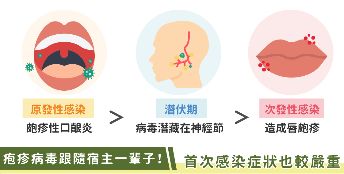 疱疹性口龈炎