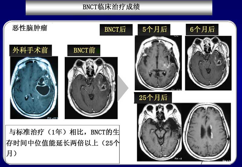 BNCT案例 | 恶性神经胶质瘤的硼中子俘获治疗