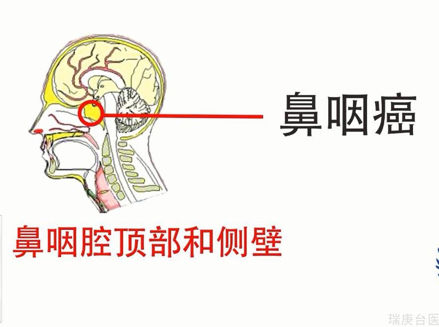 复发鼻咽癌 | 质子治疗有明显优势