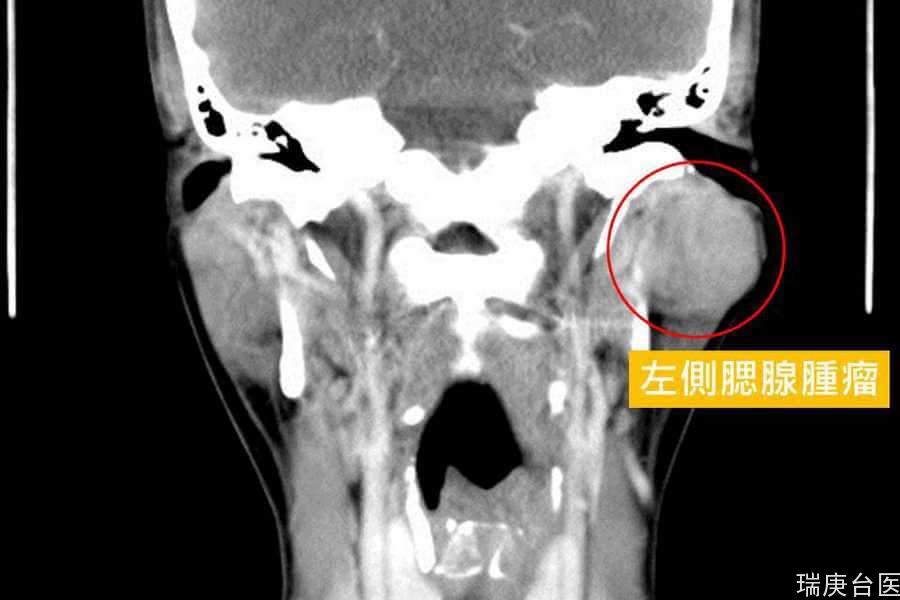 颜面神经痛竟可能是「腮腺肿瘤」！ 3大症状有癌变可能