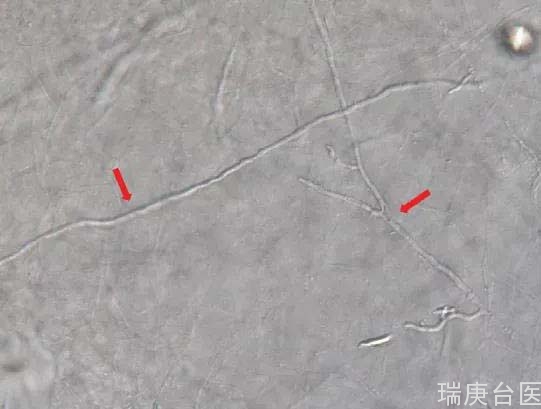 【台湾长庚医院】我得了灰指甲、香港脚了吗？