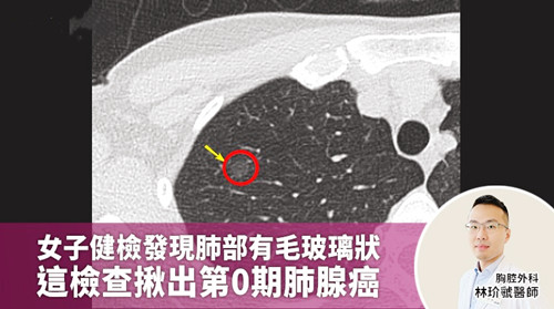 女子健检发现肺部有毛玻璃状 这检查揪出第0期肺腺癌