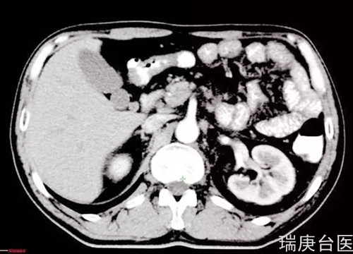 案例分享 | 食管癌腹膜后淋巴结转移 ,质子治疗肿瘤完全消失