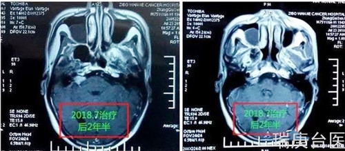 质子治疗案例 | 听神经瘤五年后复查肿瘤几近消失