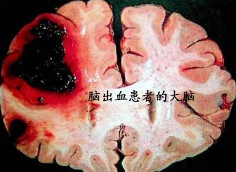 急性脑出血患者的康复过程患者们知道了吗?